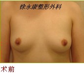 隆乳前照片