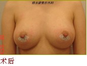 隆乳后照片