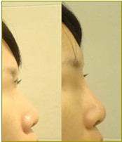 微晶瓷玻尿酸隆鼻效果前后对比