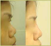 微晶瓷玻尿酸隆鼻效果前后对比