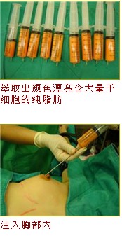 台湾徐永康整形外科，自体脂肪干细胞隆乳丰胸,