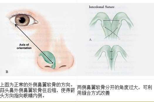 台湾风华蒜头鼻治疗