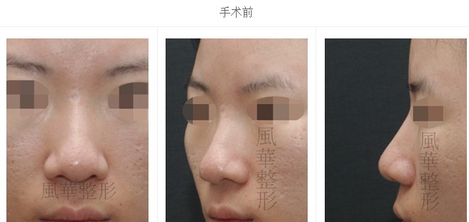 治疗前,蒜头比治疗治疗前后对比图